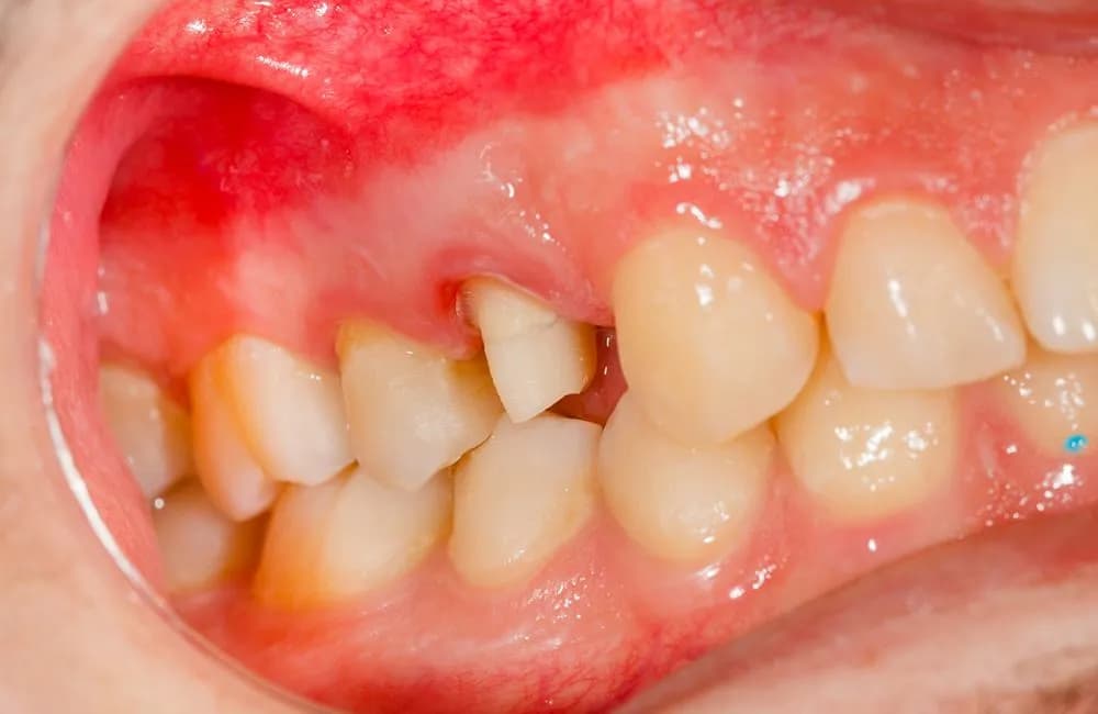 Zapalenie dziąseł u dziecka objawy, które mogą zaniepokoić rodziców