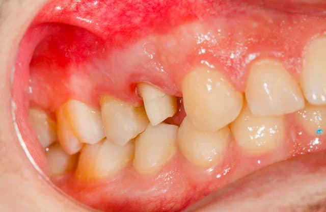 Zapalenie dziąseł u dziecka objawy, które mogą zaniepokoić rodziców