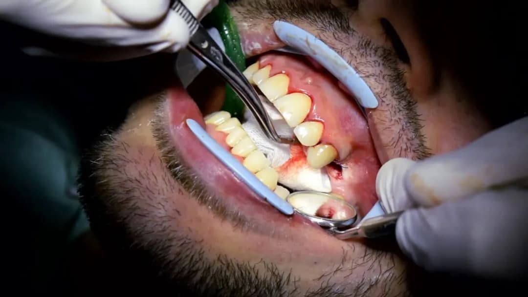 Ile trwa wyrywanie zęba 5? Czas zabiegu, który może zaskoczyć