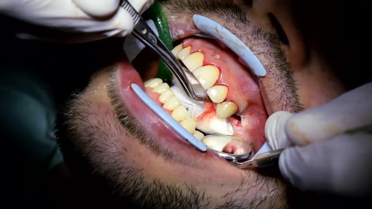 Ile trwa wyrywanie zęba 5? Czas zabiegu, który może zaskoczyć