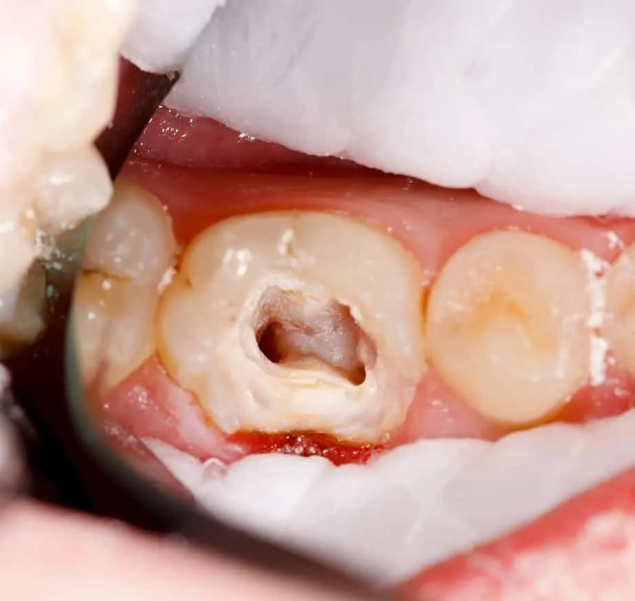 Ząb 6 ile kanałów? Zaskakujące fakty o liczbie kanałów w trzonowcach