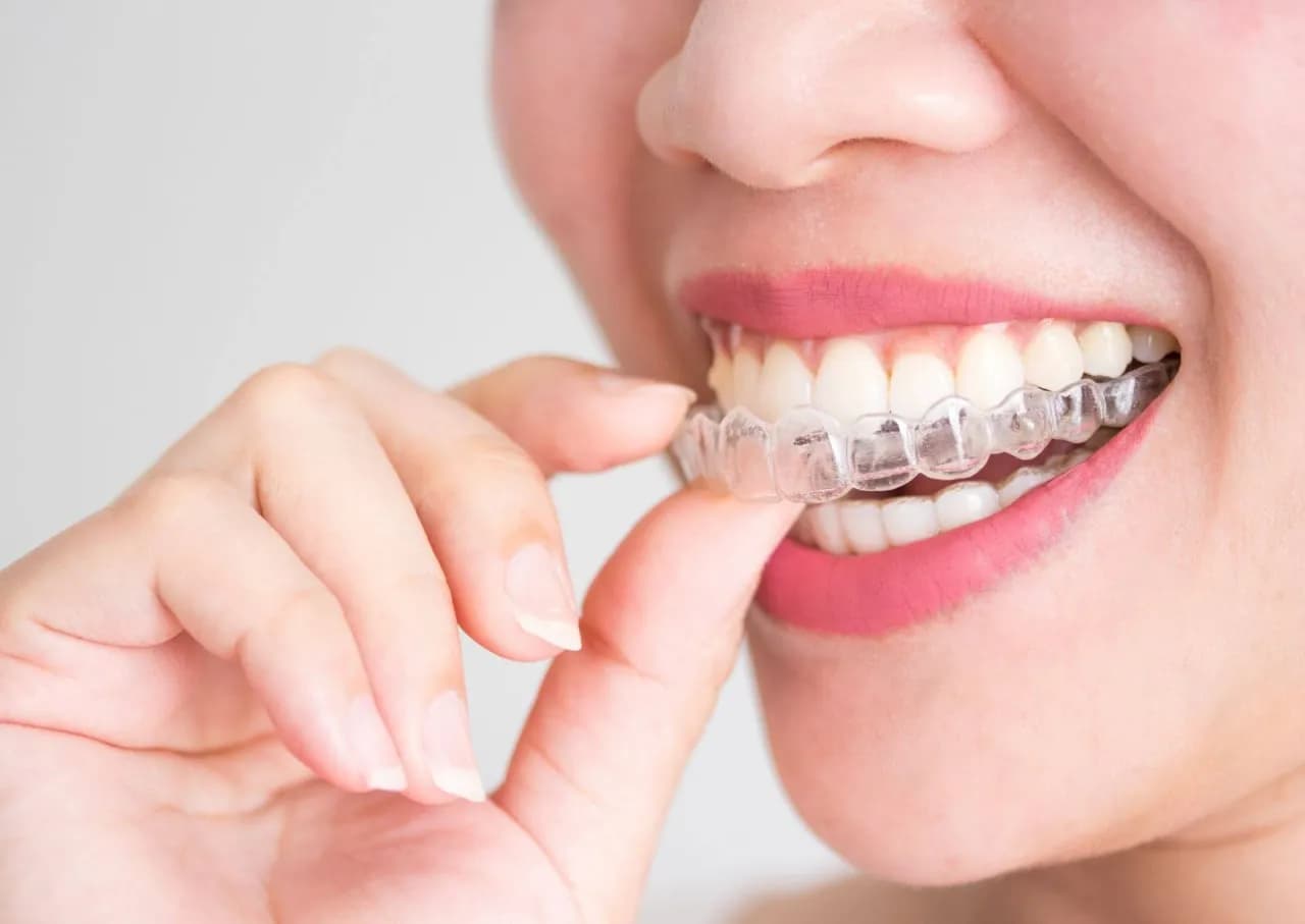 Jakie są aparaty na zęby? Odkryj ich rodzaje i skuteczność