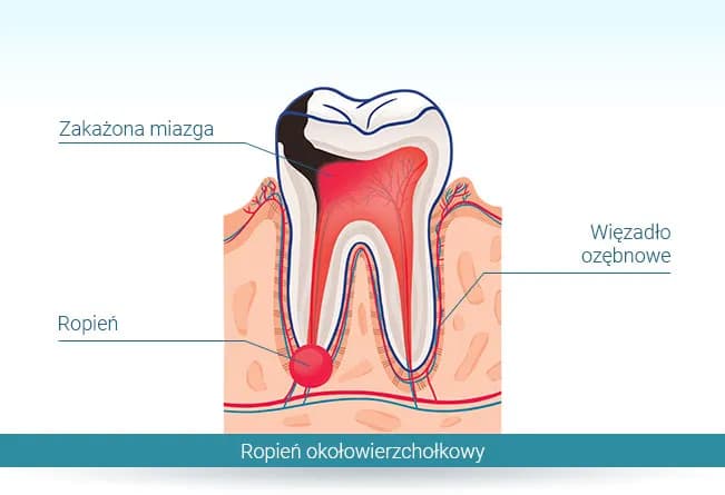 Co na ropę w dziąśle? Skuteczne sposoby na ulgę i leczenie