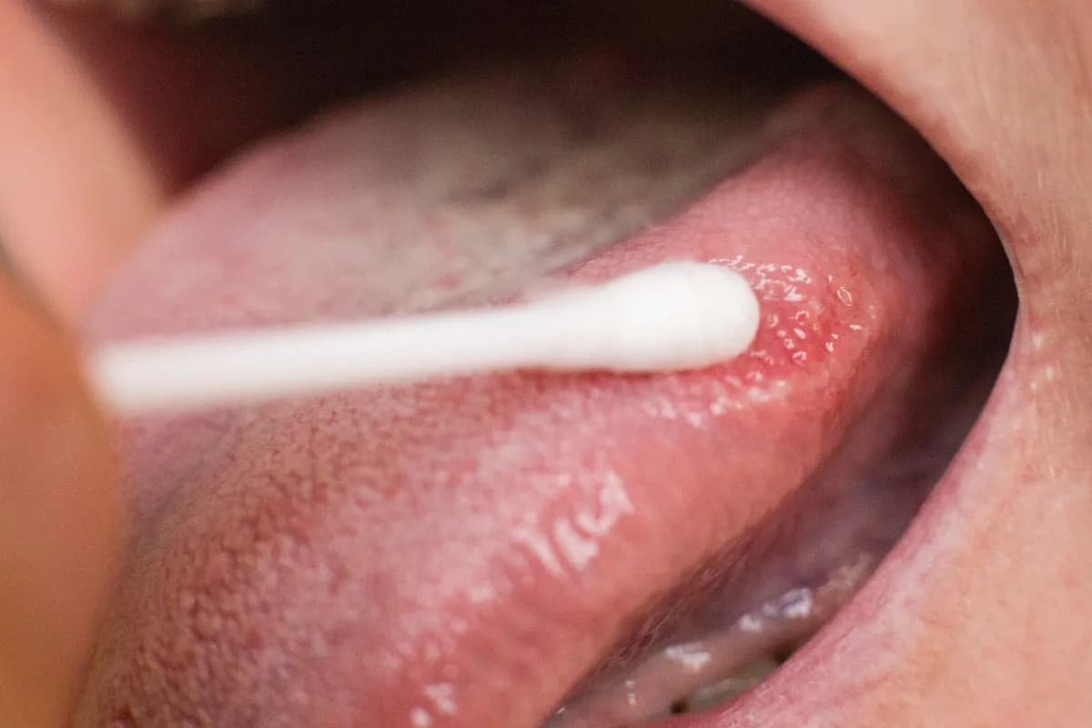 Jak wykonać pędzlowanie jamy ustnej, aby skutecznie zwalczyć pleśniawki