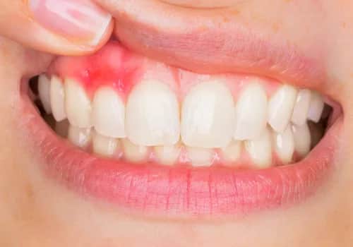 Zapalenie dziąseł od czego: poznaj przyczyny i uniknij problemów