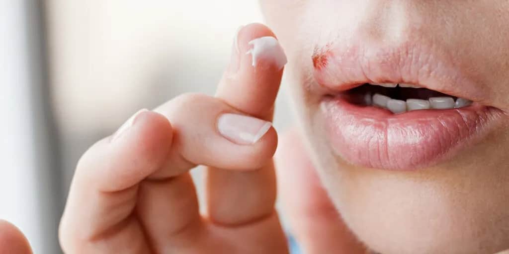 Jak leczyć ospę w jamie ustnej i złagodzić ból skutecznie