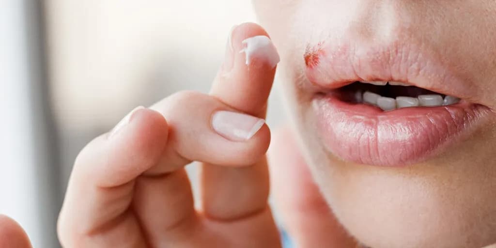 Jak leczyć ospę w jamie ustnej i złagodzić ból skutecznie
