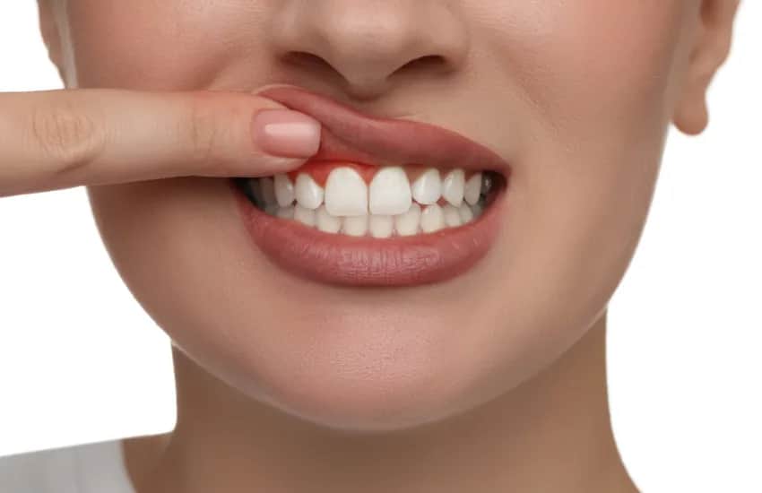 Skuteczne sposoby na podrażnione dziąsła - ulga i szybkie leczenie