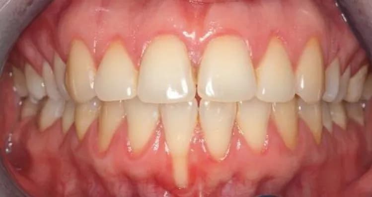 Ile kosztuje przeszczep dziąsła? Ceny w Polsce i różnice w klinikach