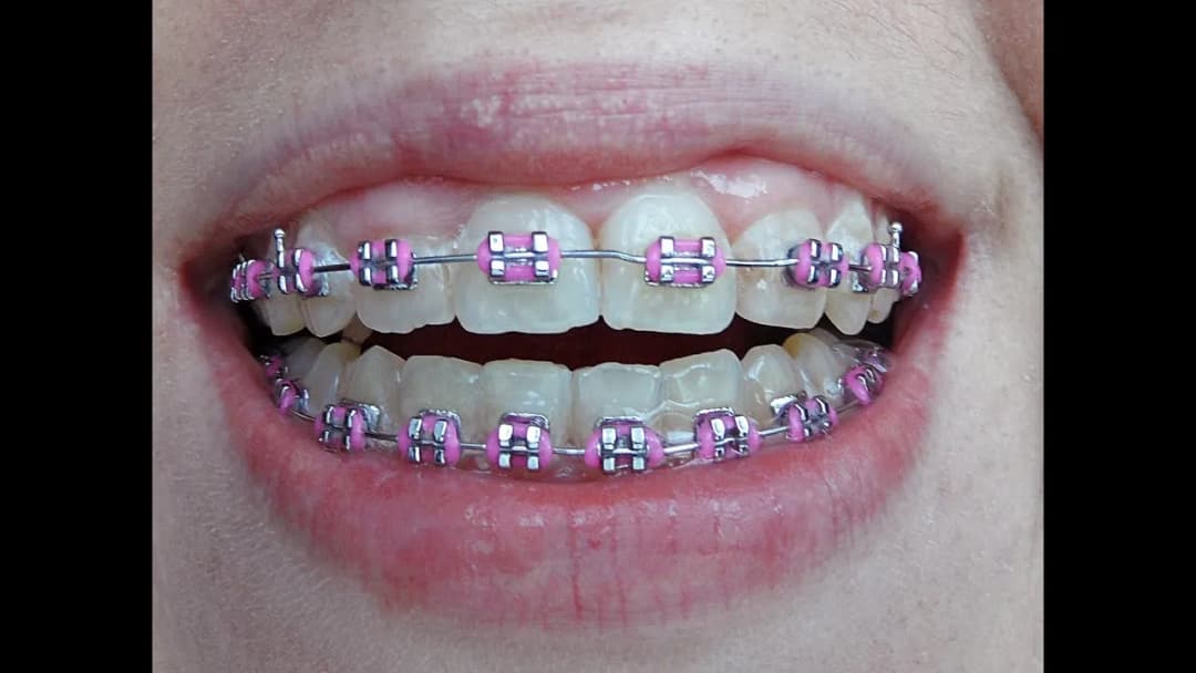 Jak wyglądają aparaty na zęby? Odkryj różnice i estetykę