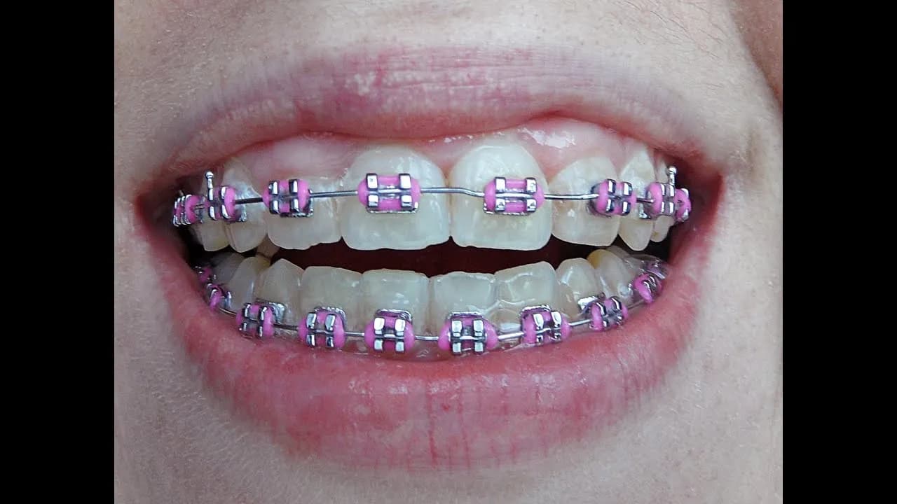 Jak wyglądają aparaty na zęby? Odkryj różnice i estetykę