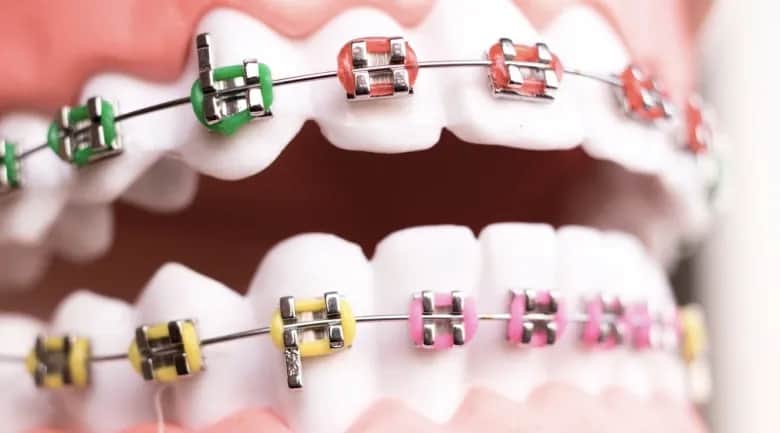 Jak działa aparat na zęby? Poznaj sekrety skutecznej ortodoncji