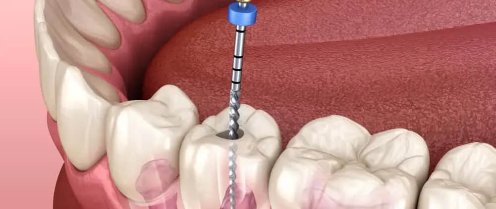 Jak długo wytrzyma ząb leczony kanałowo? Odkryj zaskakujące fakty