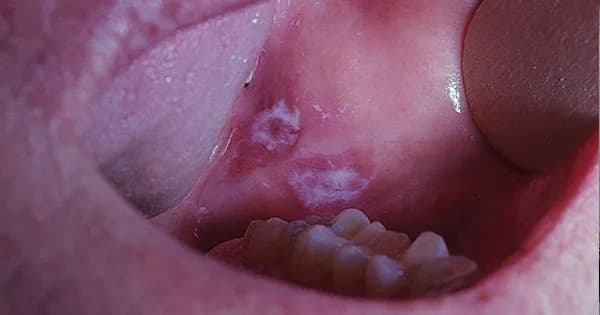 Jak skutecznie leczyć rany w jamie ustnej i uniknąć bólu