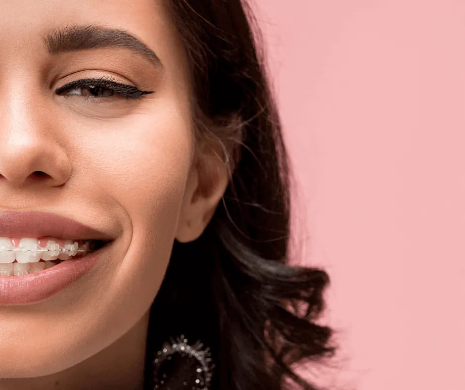 Jak wygląda stały aparat na zęby? Poznaj jego różne typy i wygląd